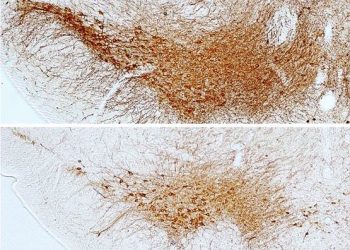 La diabetes constituye un factor de riesgo para desarrollar párkinson