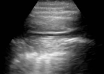Investigadores del CSIC desarrollan un ecógrafo pulmonar para la detección y seguimiento de la Covid-19