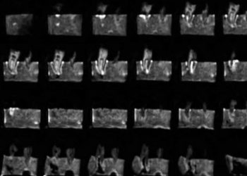 El CSIC patenta una técnica para la detección rápida de tejidos duros en resonancias magnéticas de bajo coste