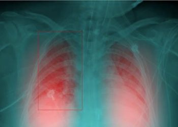 Investigadores del CSIC utilizan inteligencia artificial para identificar neumonías de pacientes de Covid-19