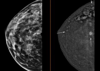 La Unidad de Mama de Ribera Salud pone en marcha la mamografía 3D