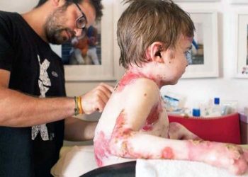 elda-petrer-piel-de-mariposa-enfermedades-raras-febrero-2020