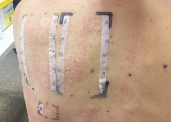 pruebas-alergia-parche-noviembre-2019-1