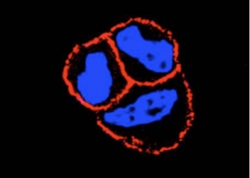 El uso combinado de un nuevo fármaco mejora la eficiencia de algunos tratamientos de cáncer de mama