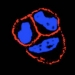 El uso combinado de un nuevo fármaco mejora la eficiencia de algunos tratamientos de cáncer de mama