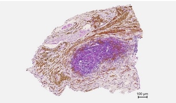 Un nuevo tratamiento contra el cáncer de páncreas estimula las defensas y frena el crecimiento tumoral en ratones