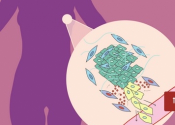 Un gen presente en las células que rodean los tumores es clave en la progresión del cáncer de mama