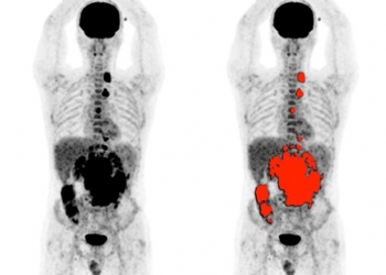 El CSIC participa en un proyecto para desarrollar un escáner PET de cuerpo entero y con mayor sensibilidad