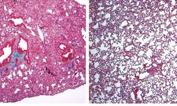 Investigadores del CSIC muestran la eficacia de la molécula cortistatina para tratar la fibrosis pulmonar