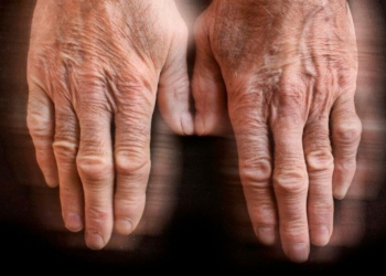 Estimulación cerebral profunda para tratar el Parkinson