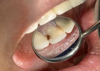 La caries en España se estanca