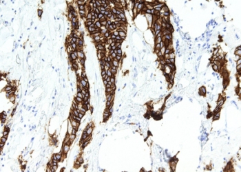 Identificada una firma genética vinculada al pronóstico del cáncer de mama