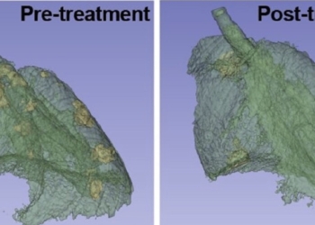 Identifican una nueva diana terapéutica para el cáncer de pulmón más frecuente
