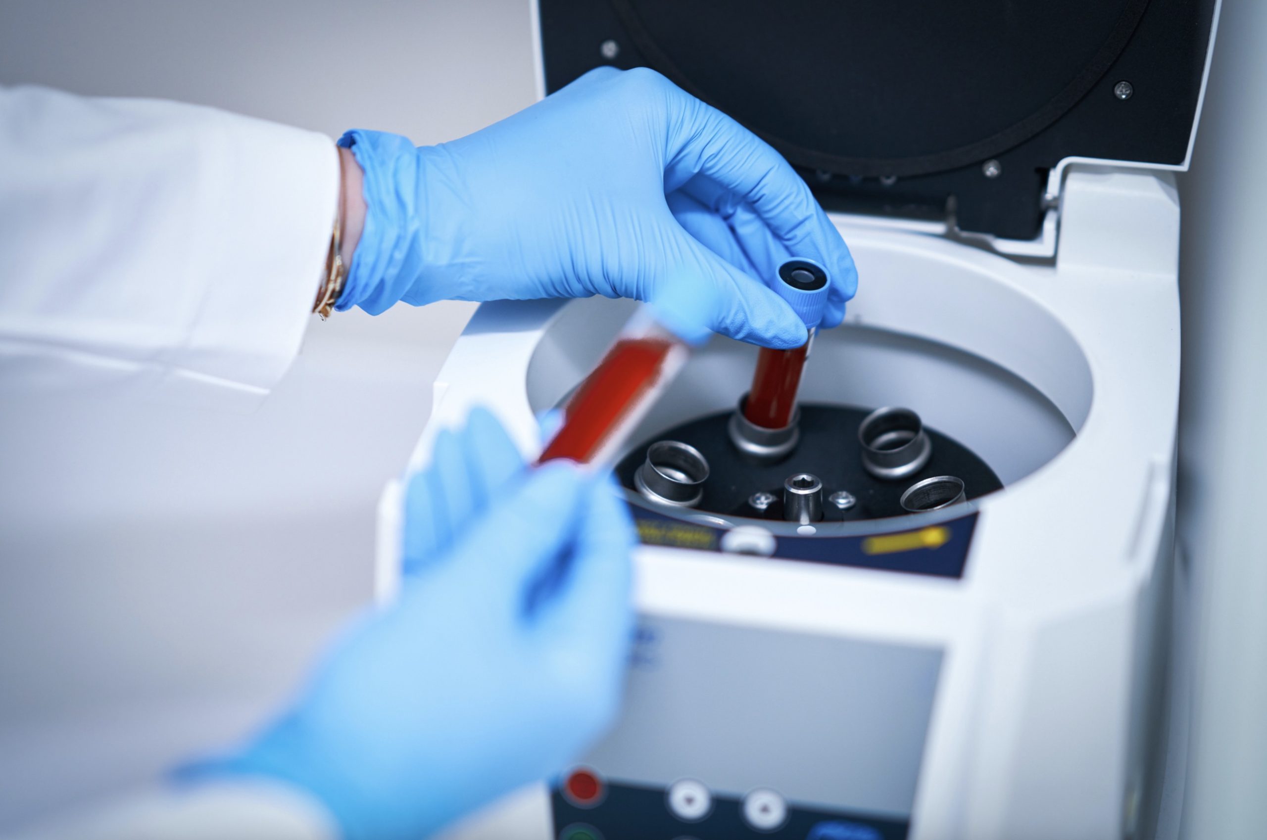 Un análisis genético de una muestra de sangre podría detectar el párkinson antes de los primeros síntomas