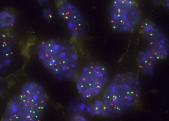 Una proteína actúa como barrera natural frente a la progresión del cáncer de pulmón