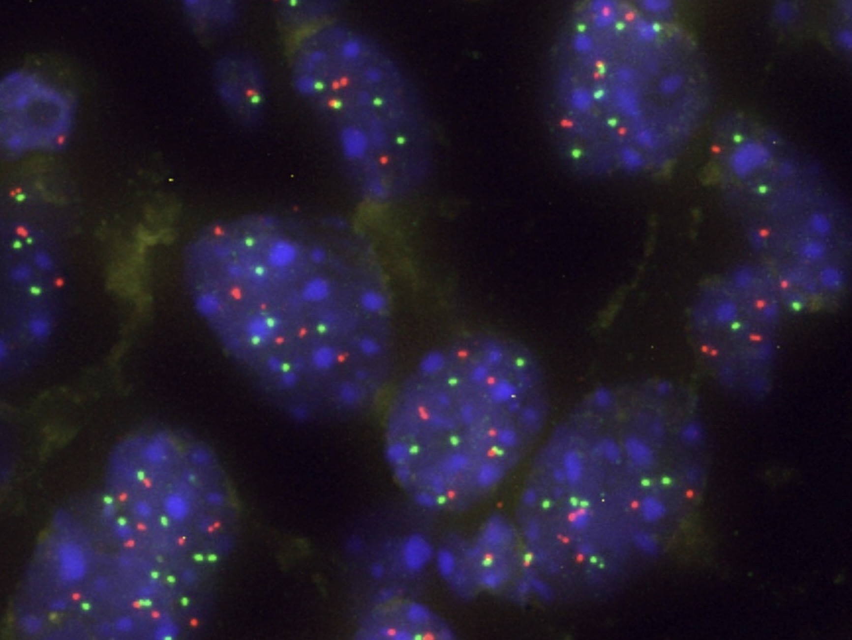 Una proteína actúa como barrera natural frente a la progresión del cáncer de pulmón